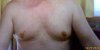 Breasts Starting out Dec 2009.jpg